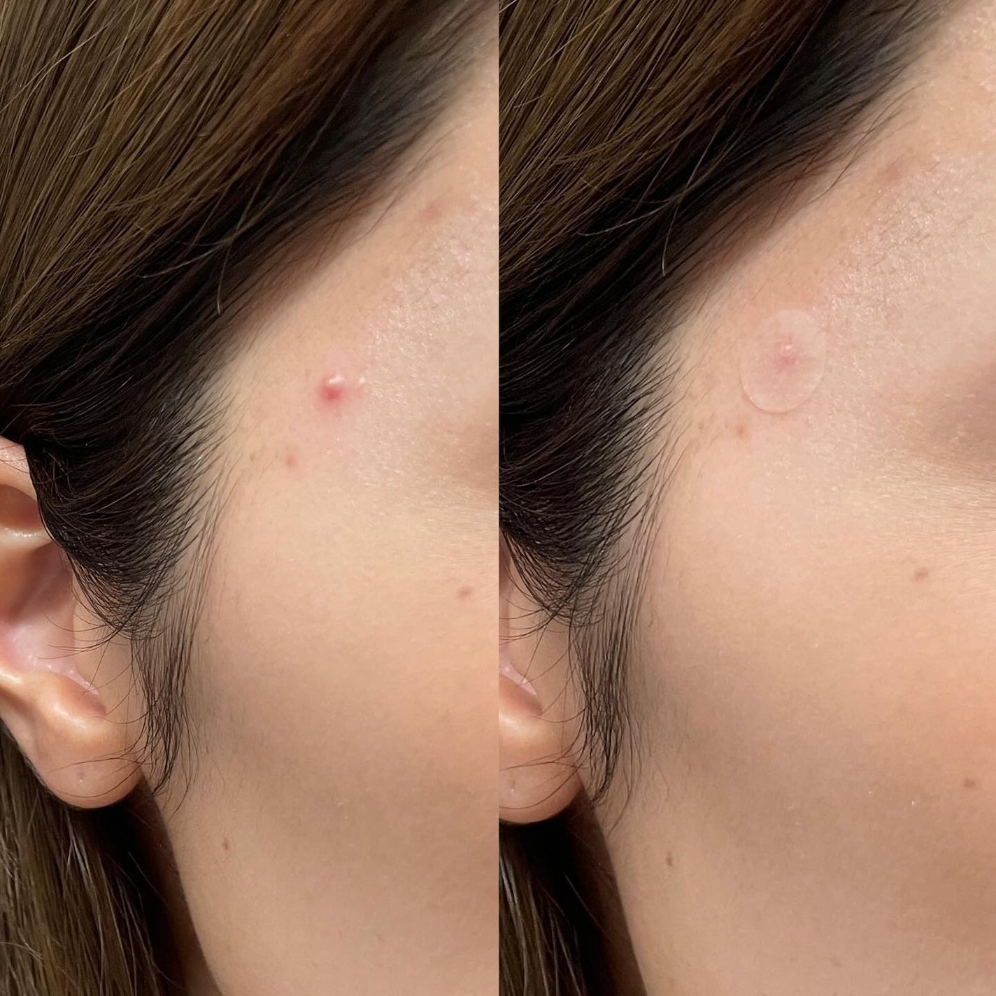 SPOT PATCH ロールタイプ/Shupong/にきびパッチを使ったクチコミ(4枚目)