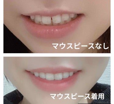 niimi⭐︎にーみ on LIPS 「※マウスピース着用写真追記しました！前歯のすきっ歯🦷見て見ぬ振..」（4枚目）