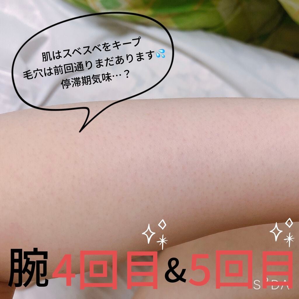 光脱毛器 VIO/Sarlisi/家庭用脱毛器を使ったクチコミ(5枚目)