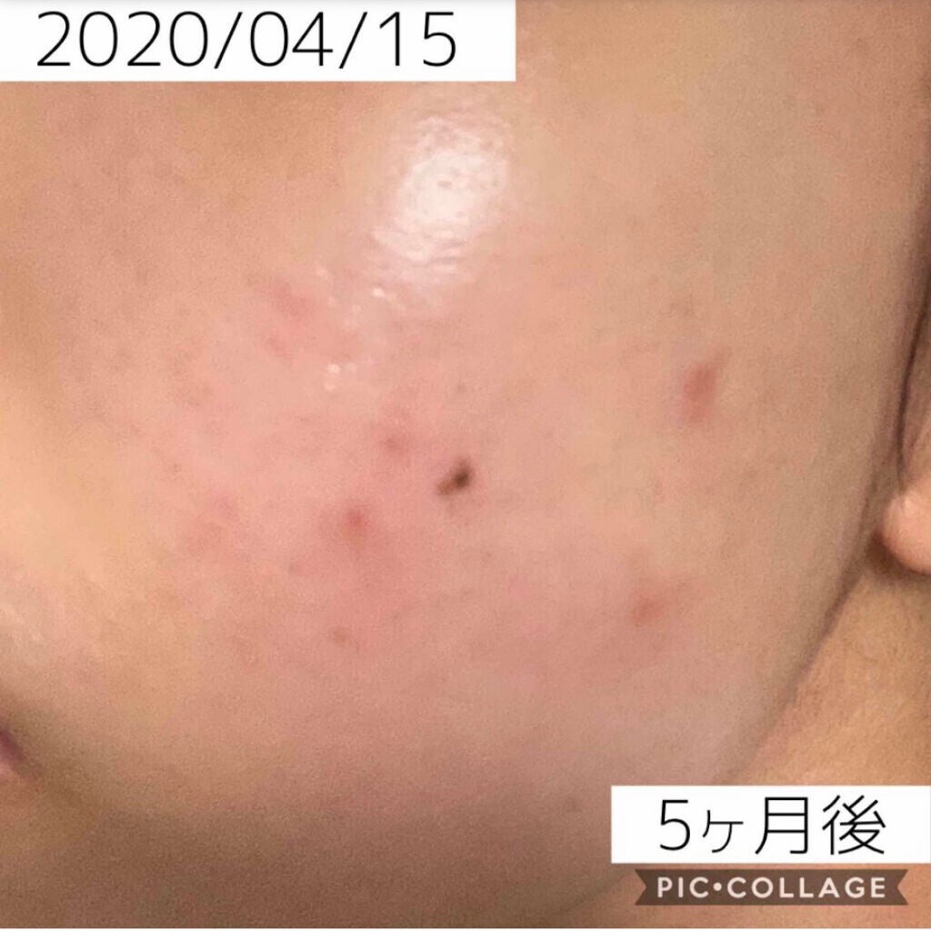 A アクネフォーム/NOV/洗顔フォームを使ったクチコミ(8枚目)