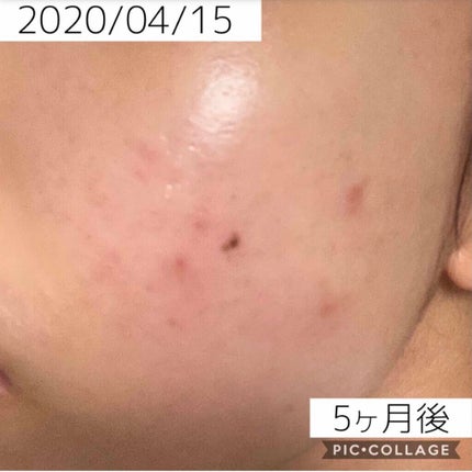 A アクネフォーム/NOV/洗顔フォームを使ったクチコミ(8枚目)