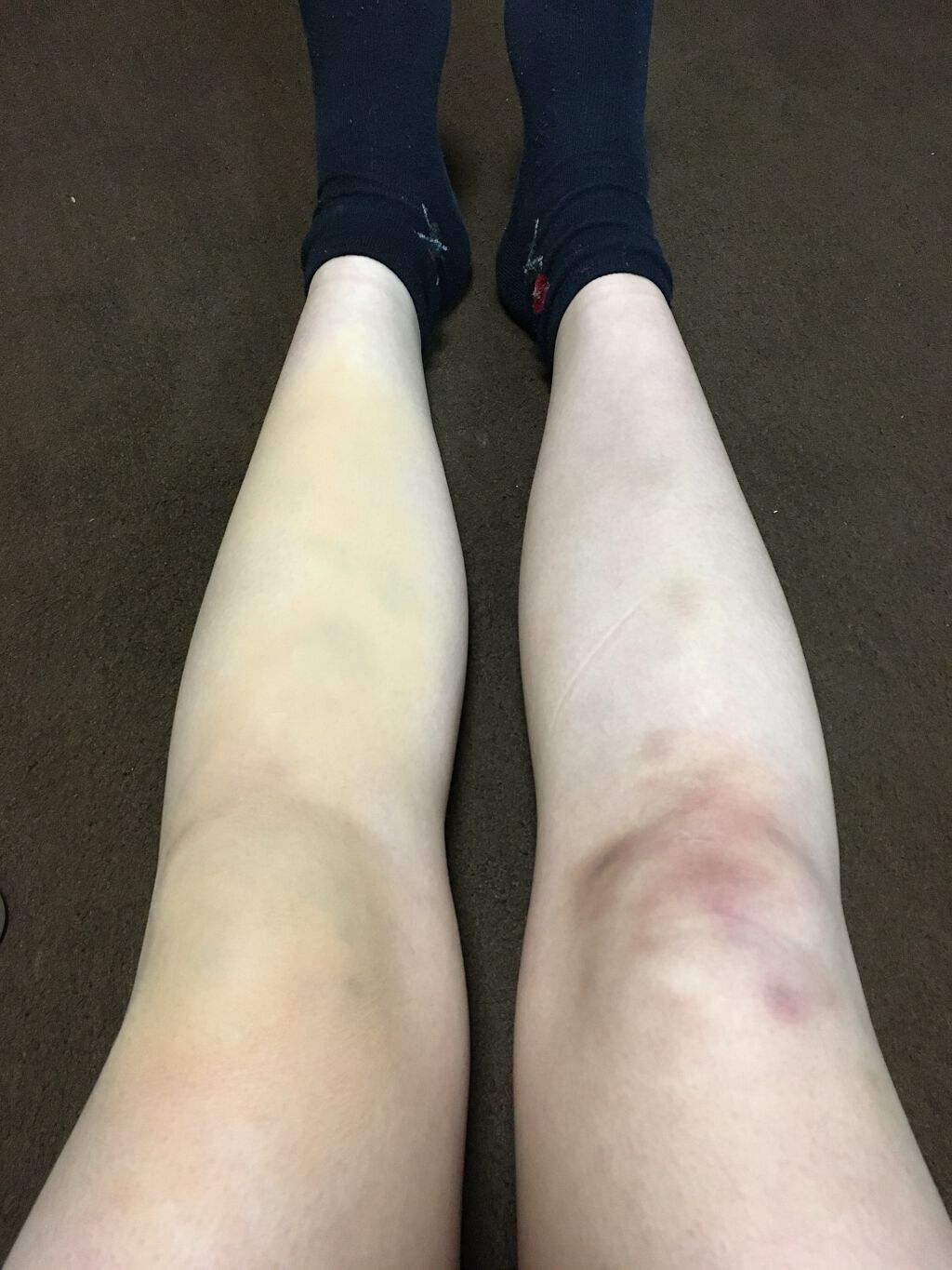 スポッツカバー ファウンデイション/SHISEIDO/クリームコンシーラーを使ったクチコミ(2枚目)