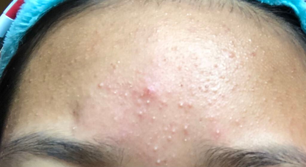 ニキビを治したい。 on LIPS 「写真で写ってる肌より現実の方がもっと荒れてます。なのでこれより..」(1枚目)