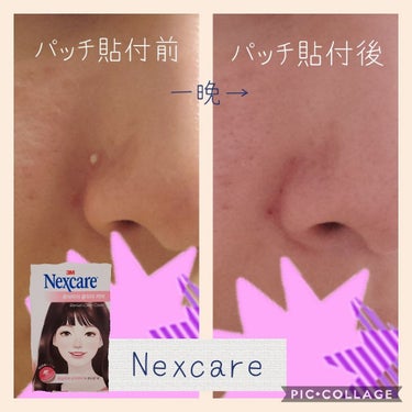 Nexcare イージー ピール/3M nexcare/にきびパッチを使ったクチコミ（1枚目）