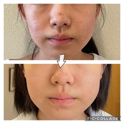 ティーツリーケアソリューション アンプルマスクJEX/MEDIHEAL/シートマスク・パックを使ったクチコミ(1枚目)