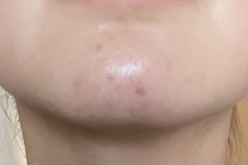 A アクネフォーム/NOV/洗顔フォームを使ったクチコミ（3枚目）