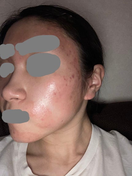 fantastic_make_9nly on LIPS 「ニキビ治療記録..」(1枚目)