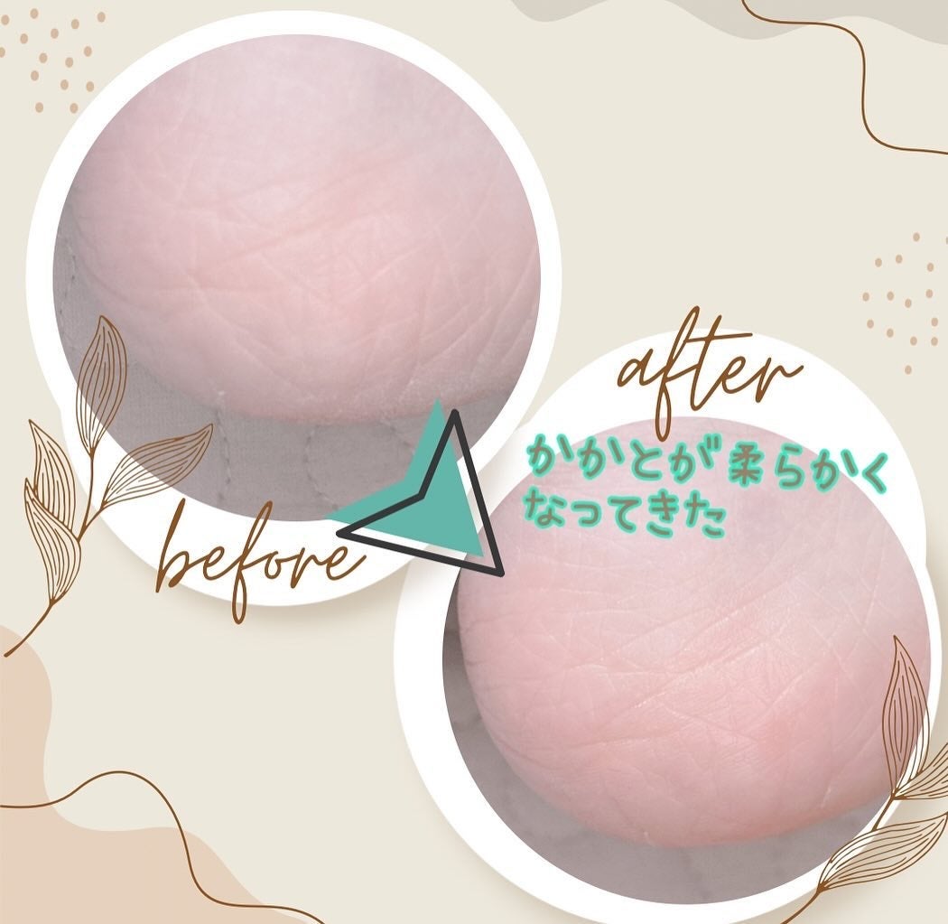 黒ハニ@フォロバ100 on LIPS 「ここ2年くらい足の裏がガサガサゾウさんの足でした🐘😂でーーもー..」(2枚目)