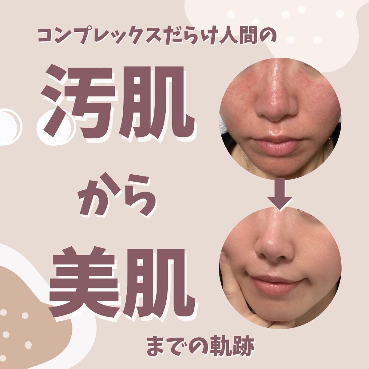 まゆめ on LIPS 「\🌟敏感肌がコンプレックスから脱却するまでにやったこと🌟/長年..」(1枚目)