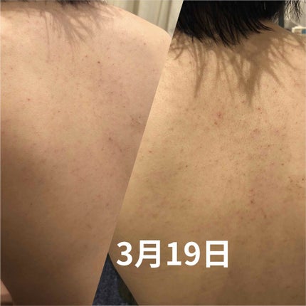 ニキビを防ぐ薬用石鹸 ForBack/ペリカン石鹸/ボディ石鹸を使ったクチコミ(2枚目)