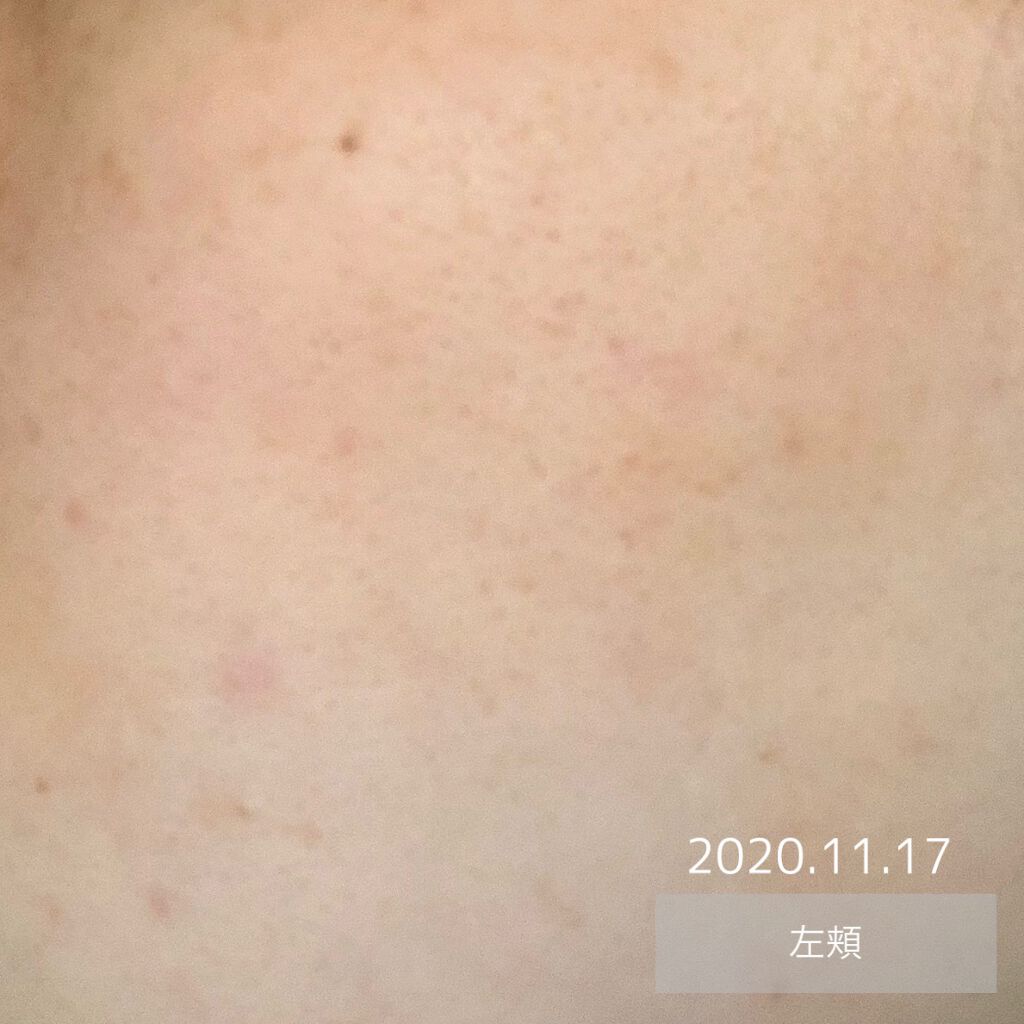 オードムーゲ 薬用ローション(ふきとり化粧水)/オードムーゲ/拭き取り化粧水を使ったクチコミ(3枚目)