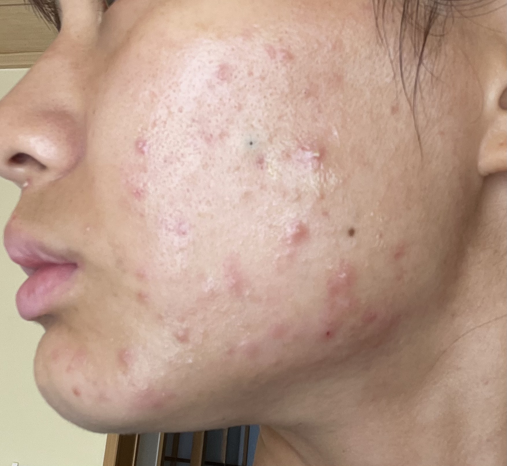 潤浸保湿 化粧水 II しっとり/キュレル/化粧水を使ったクチコミ（2枚目）