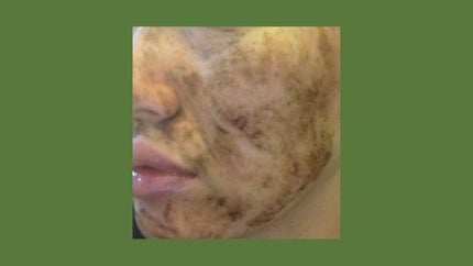 ダーマスキンピーリング/BQCELL/その他キットセットを使ったクチコミ(6枚目)