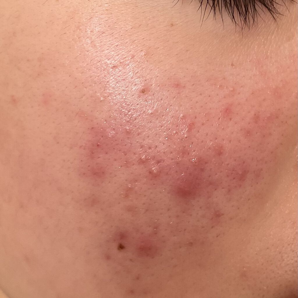 ハトムギ化粧水(ナチュリエ スキンコンディショナー R )/ナチュリエ/化粧水を使ったクチコミ（2枚目）