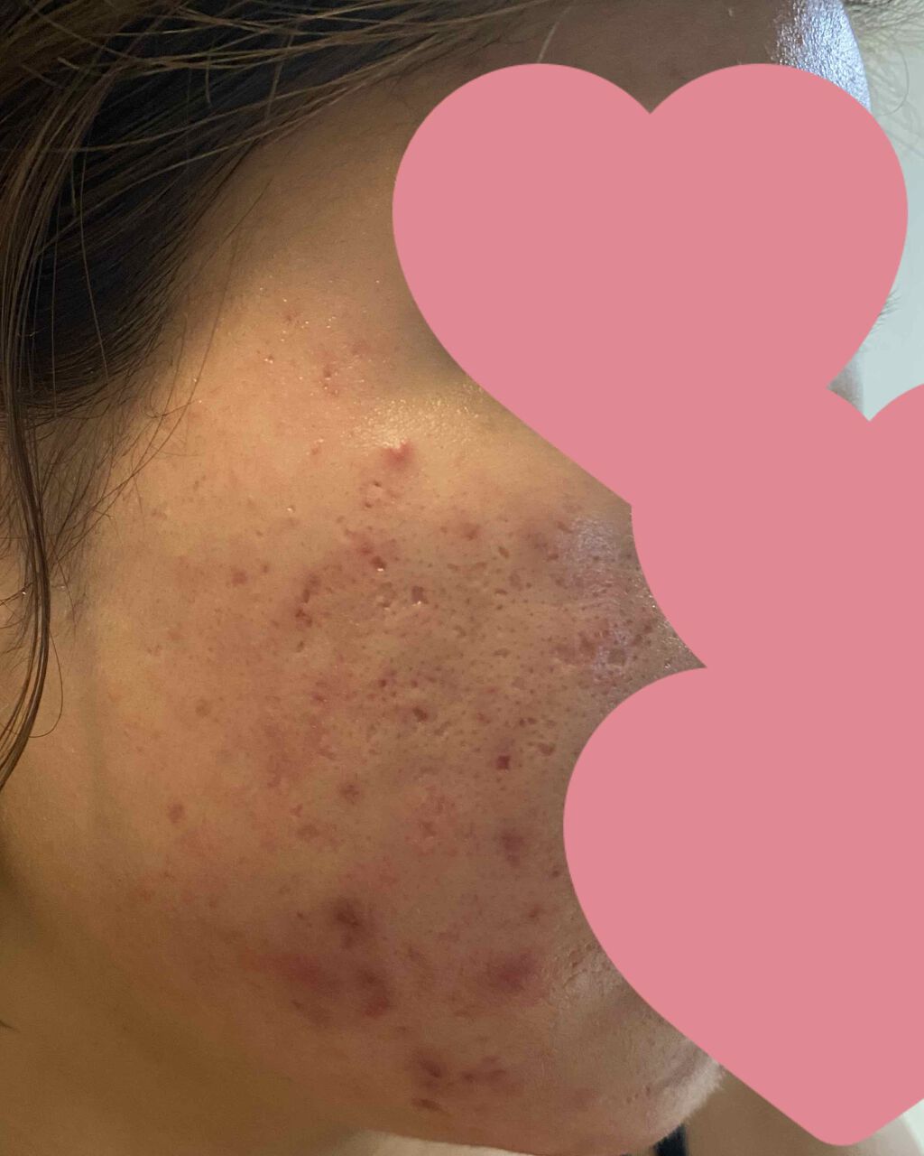 ! on LIPS 「皮膚科処方薬約2週間経過にきびはまだまだ残ってます😭でも!!鼻..」(2枚目)