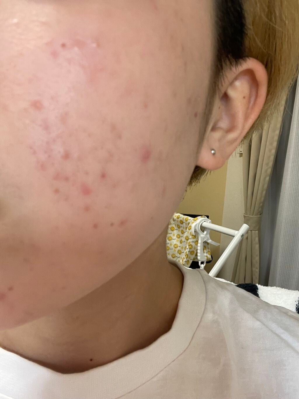 ri on LIPS 「べピオを使い始めて2ヶ月がたちました!かわってるかな?ちょっと..」(2枚目)