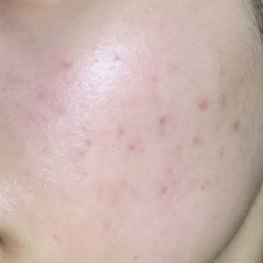 ビーソフテン ローション(医薬品)/持田製薬/その他を使ったクチコミ（1枚目）