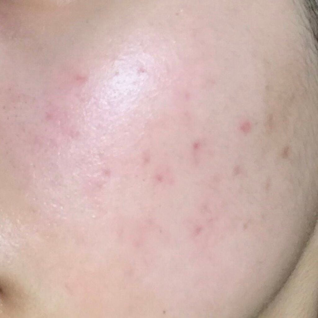 モソ on LIPS 「途中経過ほぼほぼ新規のニキビができることはなくなってきました。..」(1枚目)