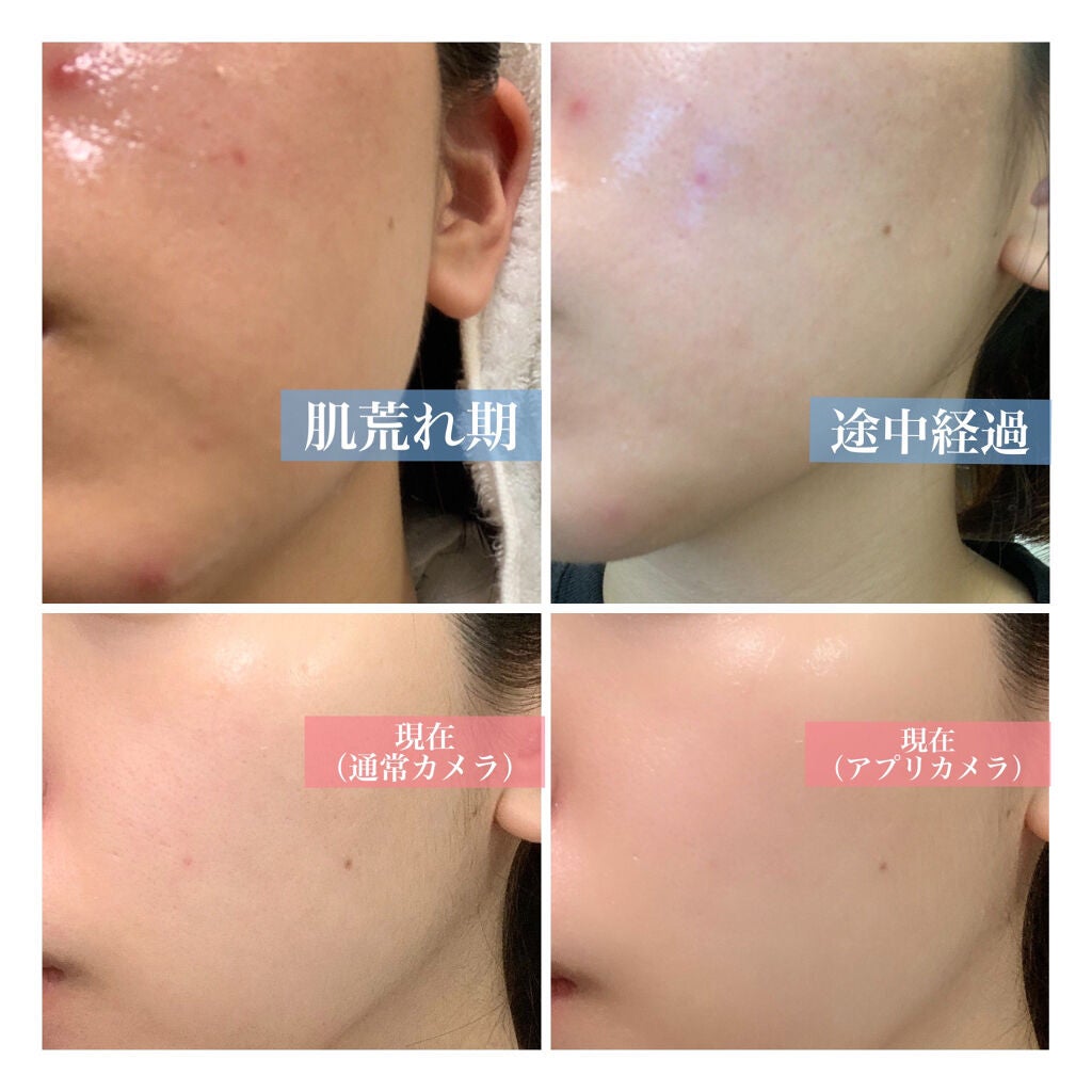 ティーツリーケアソリューション アンプルマスクJEX/MEDIHEAL/シートマスク・パックを使ったクチコミ(2枚目)