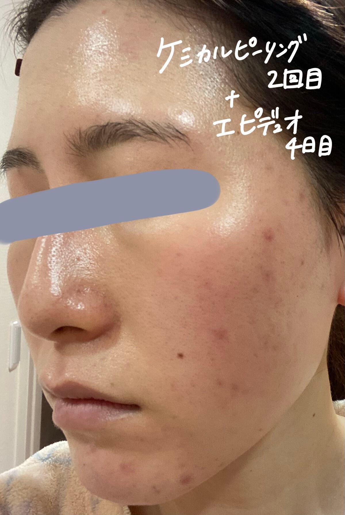 スキンピールバー ティートゥリー/サンソリット/洗顔石鹸を使ったクチコミ(6枚目)