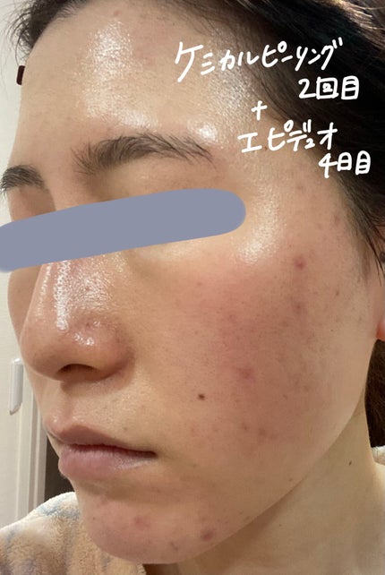 スキンピールバー ティートゥリー/サンソリット/洗顔石鹸を使ったクチコミ(6枚目)