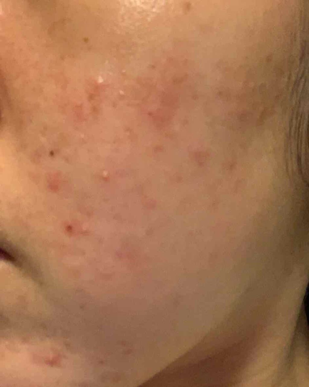 ひよこ on LIPS 「相談です。右頬と左頬の肌荒れの具合が違うのは何故なんでしょうか..」(3枚目)