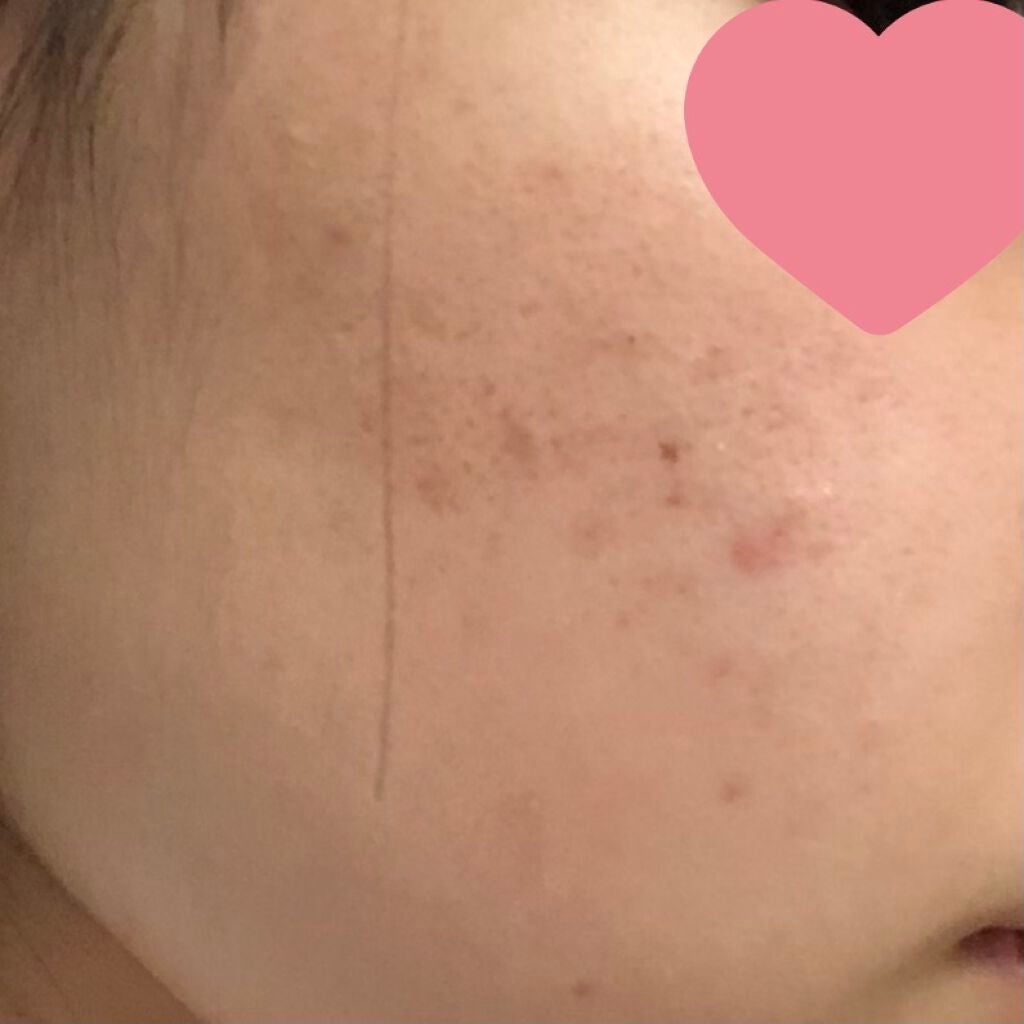 かりん on LIPS 「スキンケア初めて1週間経過✨使用しているのはビオデルマクレンジ..」(3枚目)