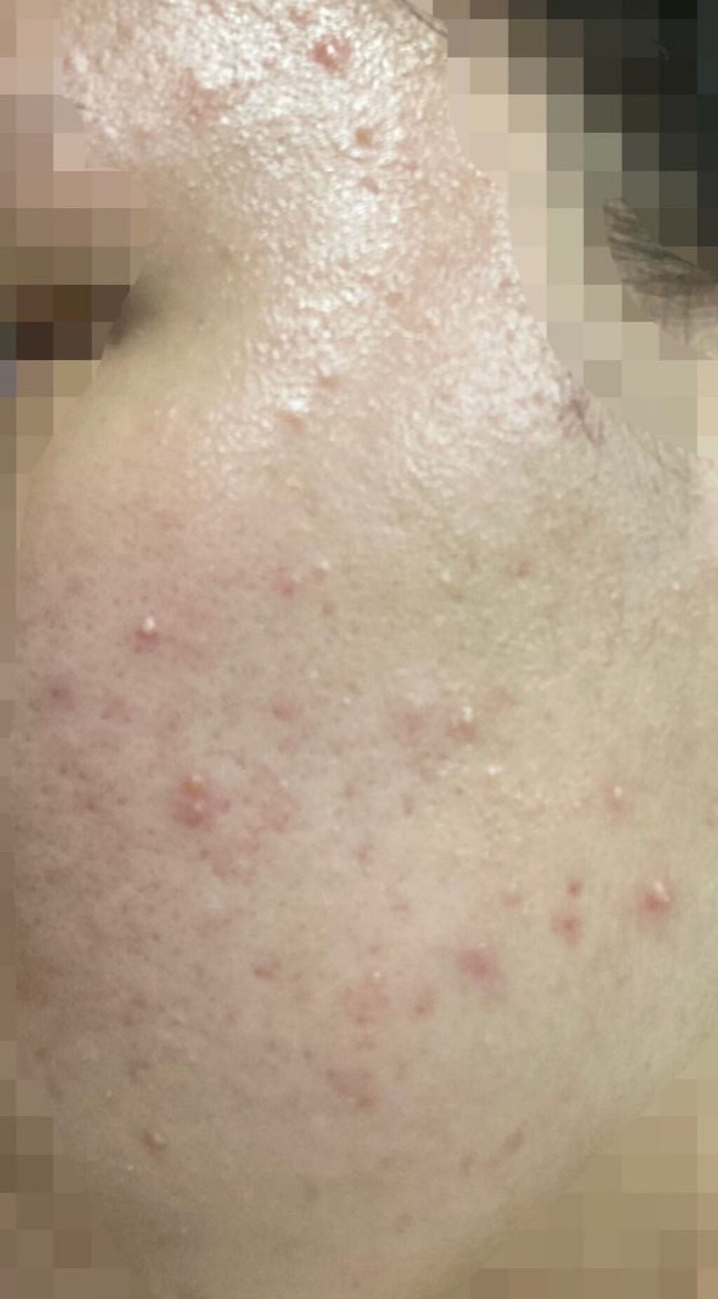 たま on LIPS 「⚠️2、3枚目観覧注意です。小4)生理はじまりおでこにニキビで..」(3枚目)