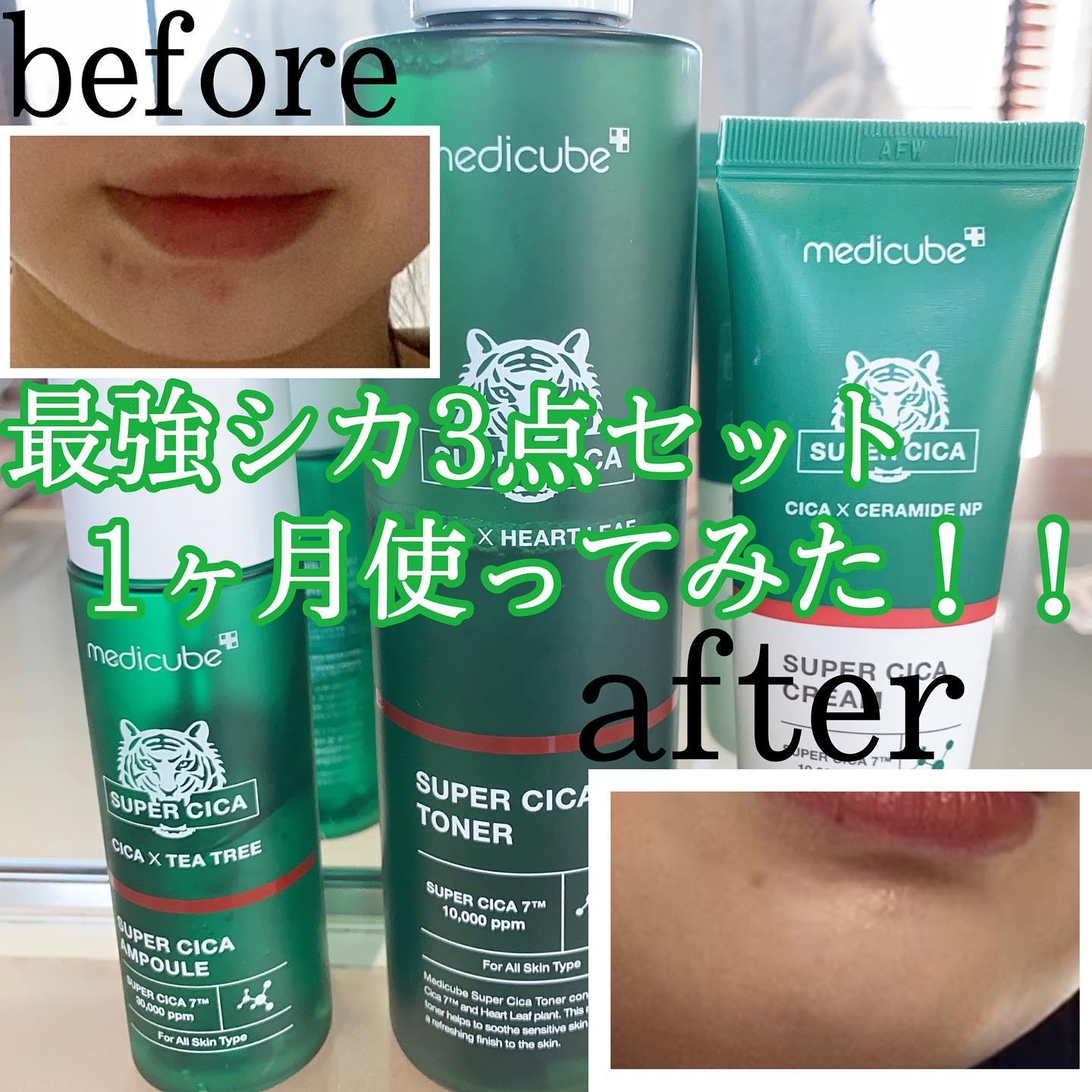 medicube 美顔器・美容液・クリーム3点セット