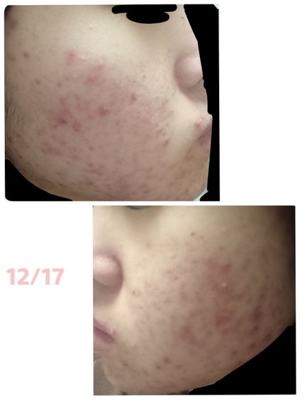 ビジャ シカスキン/innisfree/化粧水を使ったクチコミ(3枚目)