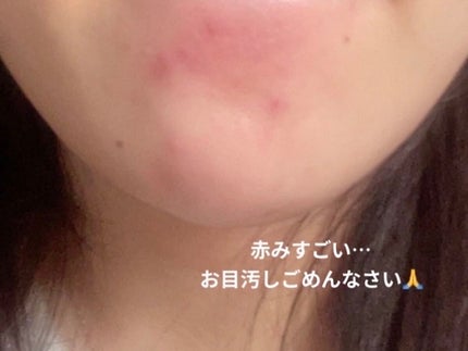 【旧】ディオールスキン フォーエヴァー スキン コレクト コンシーラー/Dior/リキッドコンシーラーを使ったクチコミ(3枚目)