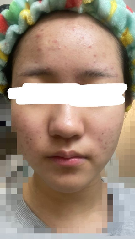 からあげまる。 on LIPS 「~助けてください~中一のマスク生活が始まってからニキビの加速が..」(6枚目)