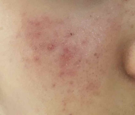 aoi on LIPS 「中学三年です。小6頃からニキビが出来始め今は写真の様な肌になっ..」(2枚目)