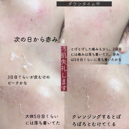 エミリー@フォロバ100 on LIPS 「・・\自宅で本格ピーリング/BQCELLダーマスキンピーリング..」(5枚目)