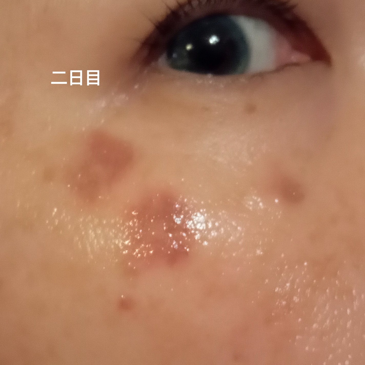 ビヨンセ奥二重向上委員長🥸LIPSパートナー🥳 on LIPS 「ついに!!この時が🤣🩷シミ取りレーザー全記録です🙌🙌🙌(五日目..」(5枚目)