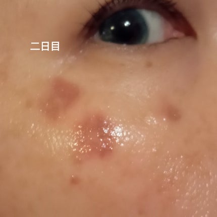 ビヨンセ奥二重向上委員長🥸LIPSパートナー🥳 on LIPS 「ついに!!この時が🤣🩷シミ取りレーザー全記録です🙌🙌🙌(五日目..」(5枚目)