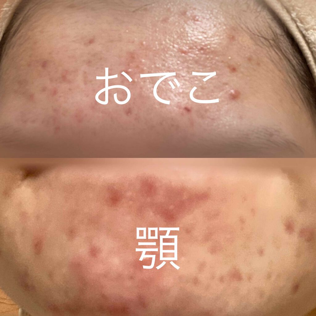 はちゃんぬ on LIPS 「こんな汚肌見せてしまってごめんなさい高3くらいからニキビがポツ..」(3枚目)