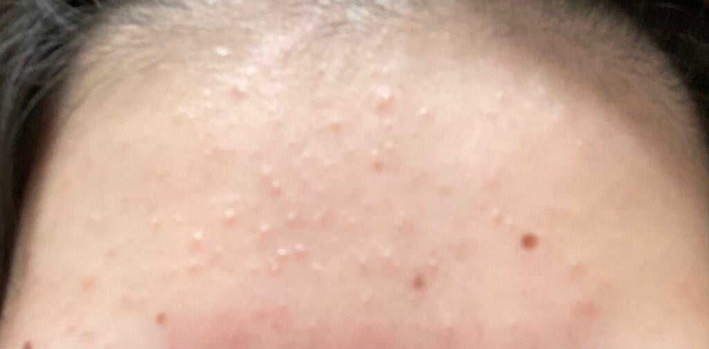 coral_gloss_dbyv on LIPS 「画像汚くてごめんなさい💦おでこのニキビが凄くて悩んでいます🥲2..」(2枚目)