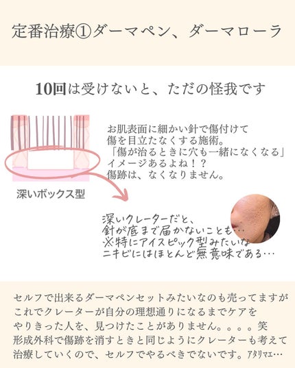 おゆみ|ニキビ・ニキビ跡ケア on LIPS 「【クレーター治療の基本のキ】こんばんは、おゆみです✨クレーター..」(4枚目)