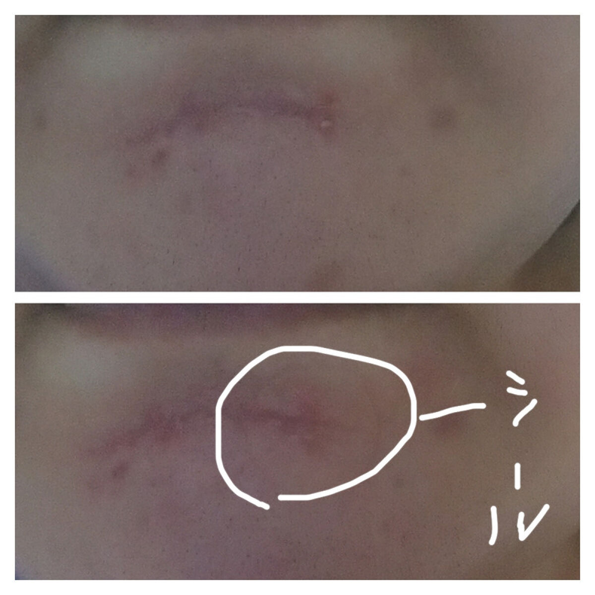 薬用 美白アクネホワイトクリーム 専用パッチ付/アクネスラボ/その他キットセットを使ったクチコミ（1枚目）