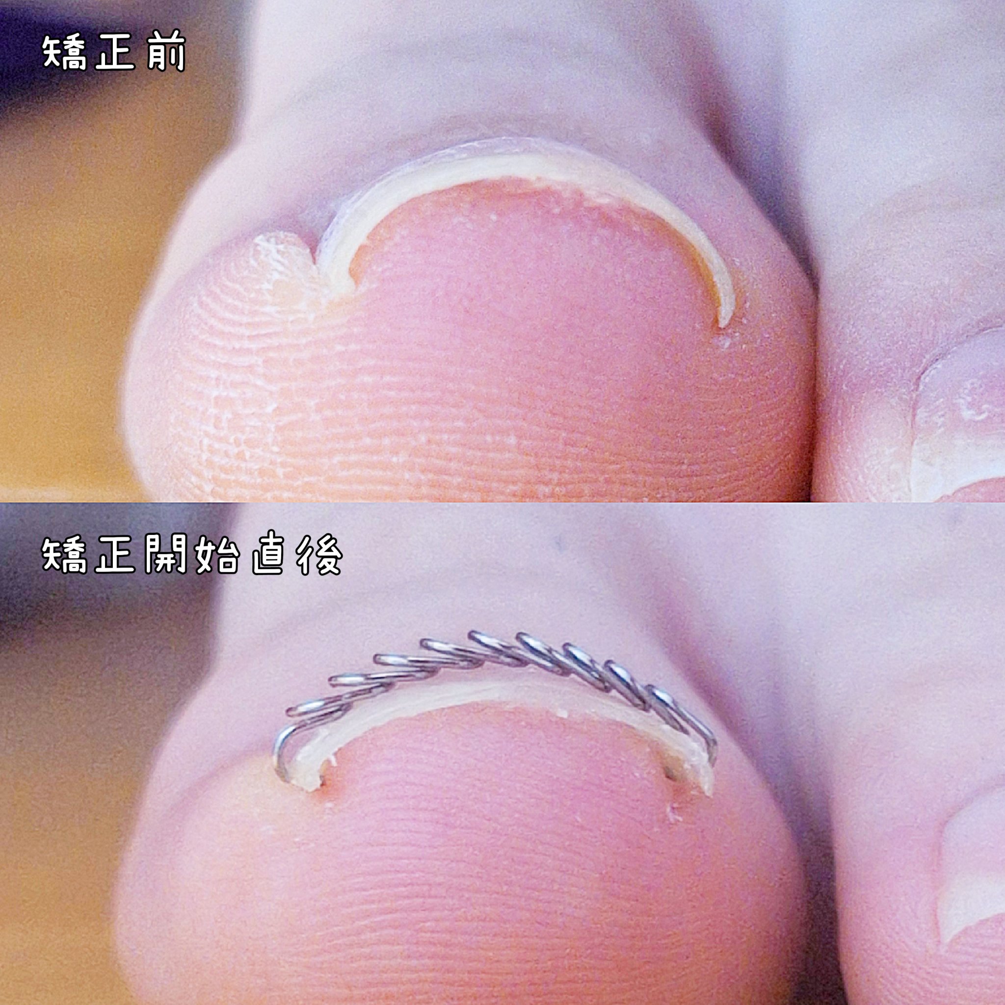Ingrown Toenails Correction Wire/jinail/ネイル用品を使ったクチコミ（2枚目）