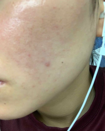 sou on LIPS 「ニキビ克服したいエピデュオゲル使い始めて5日目ヒリヒリ、カサカ..」(1枚目)