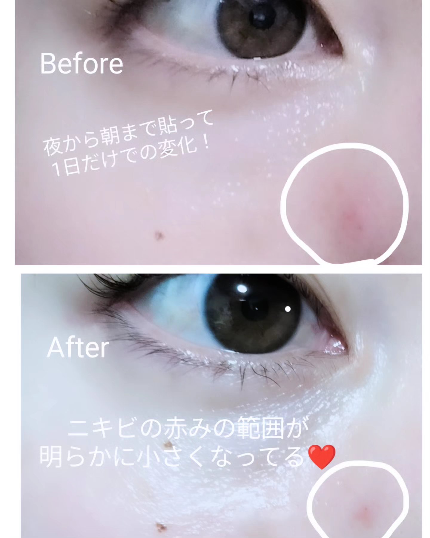 SPOT PATCH ロールタイプ/Shupong/にきびパッチを使ったクチコミ（3枚目）