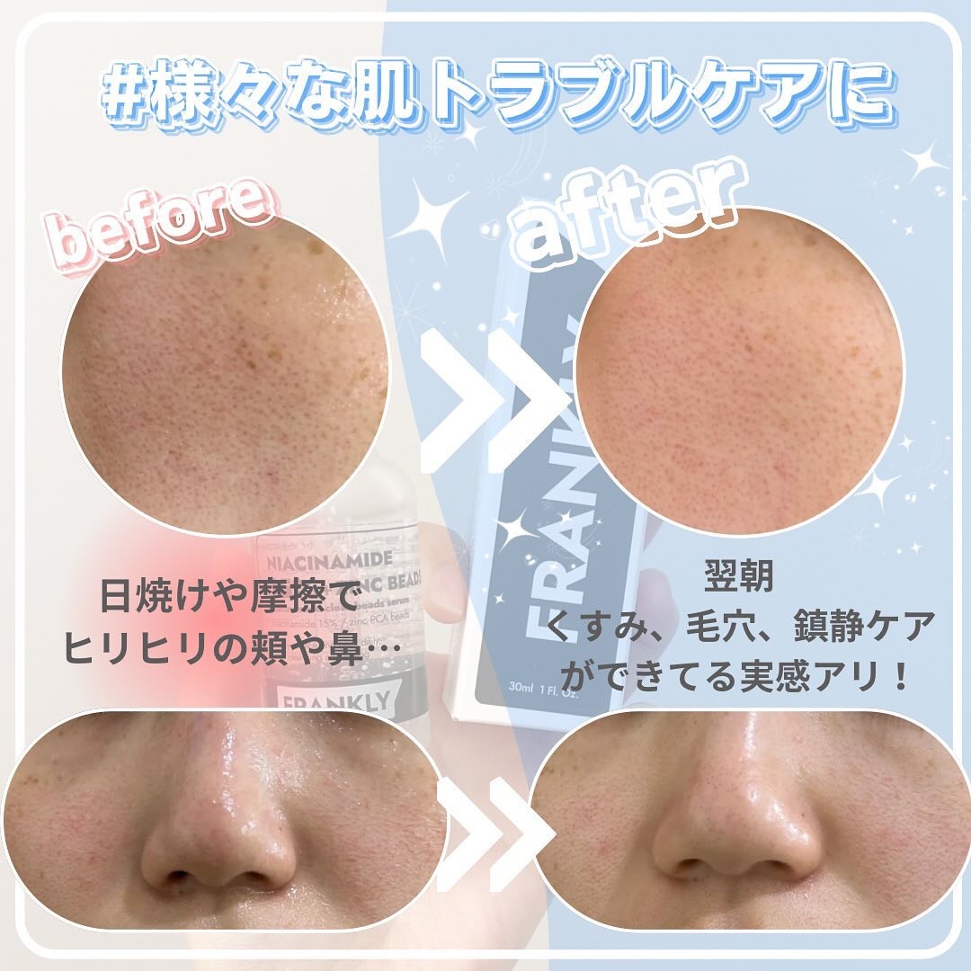 ナイアシンジンクビーズセラム/Frankly/美容液を使ったクチコミ（3枚目）