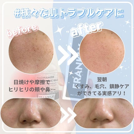 ナイアシンジンクビーズセラム/Frankly/美容液を使ったクチコミ(3枚目)