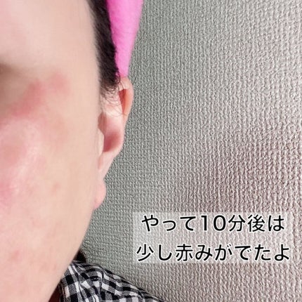セルフダーマスタンプ5種フルセット/EYE2IN/その他スキンケアグッズを使ったクチコミ(3枚目)