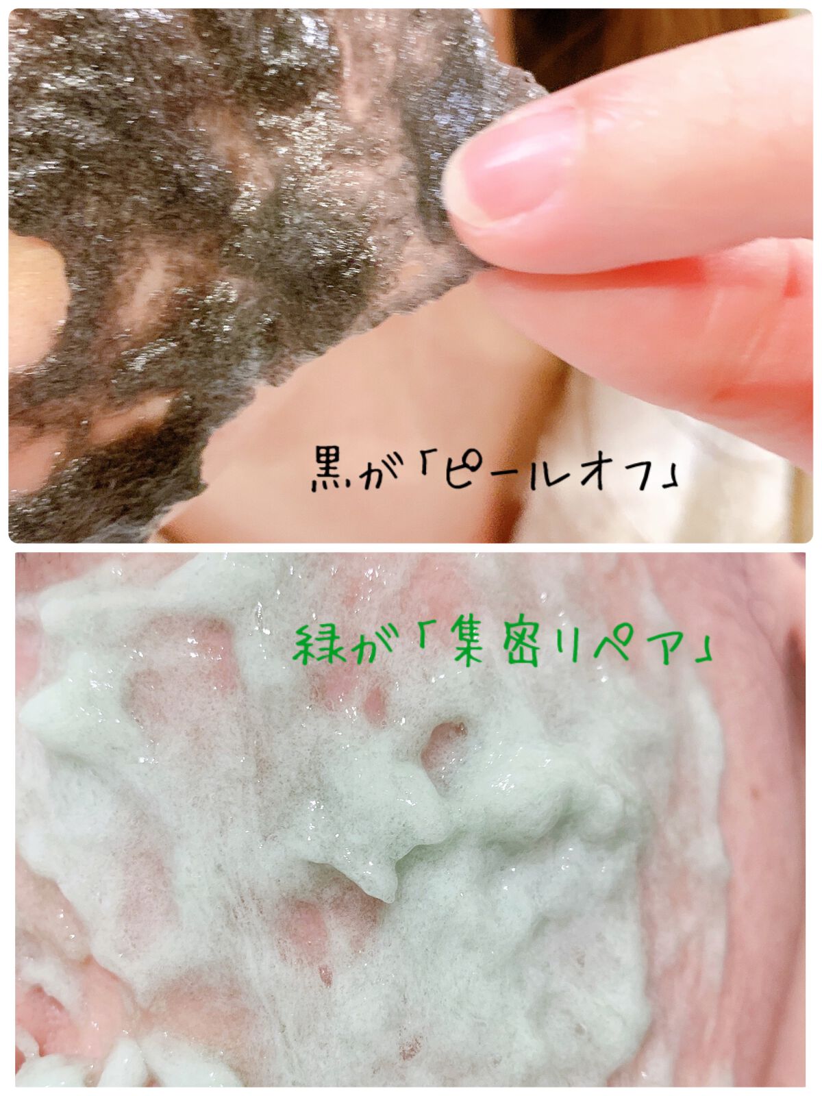 ニードル炭酸パック/NNE/洗い流すパック・マスクを使ったクチコミ(4枚目)