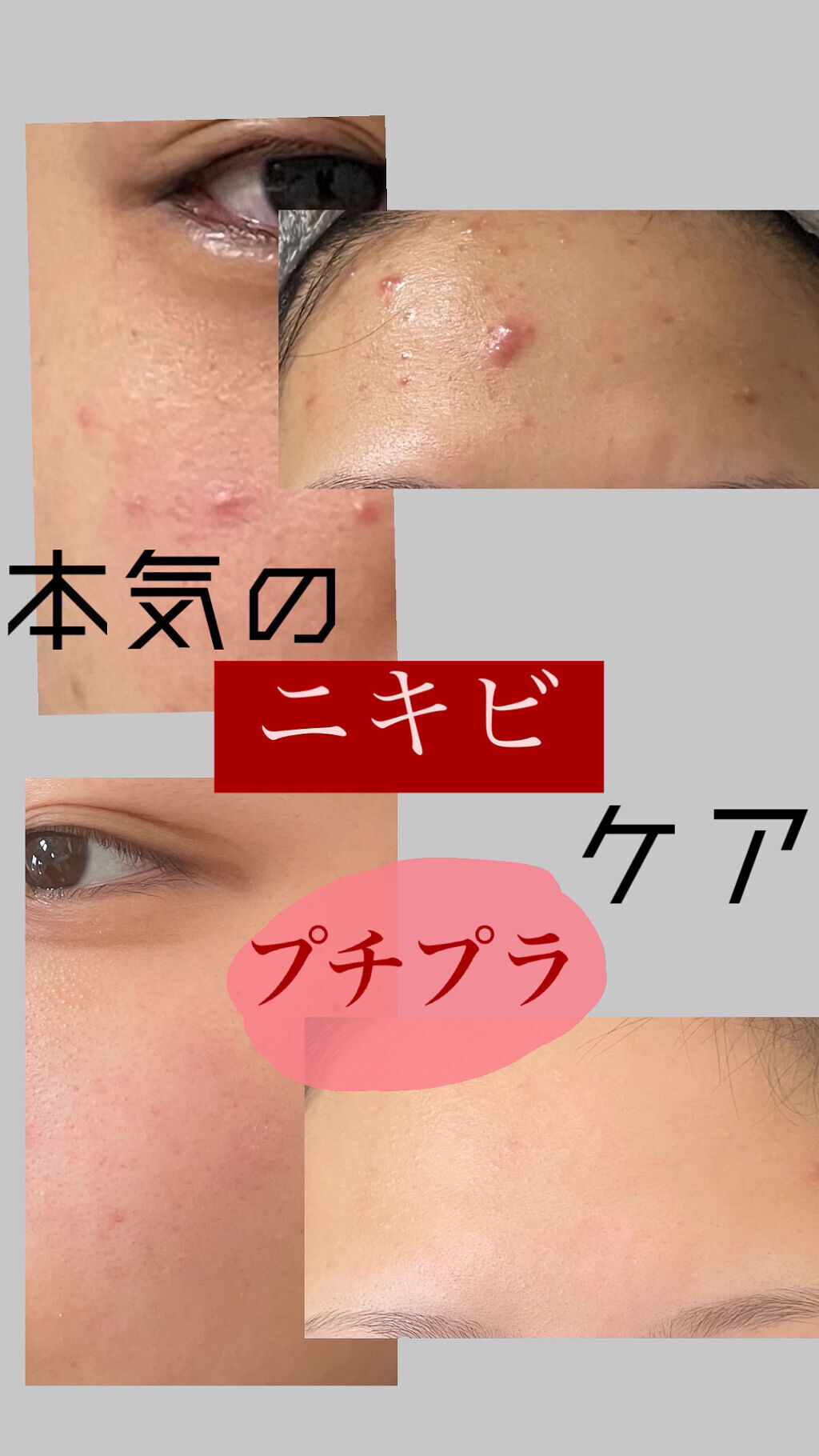 オードムーゲ 薬用ローション（ふきとり化粧水）/オードムーゲ/拭き取り化粧水を使ったクチコミ（1枚目）