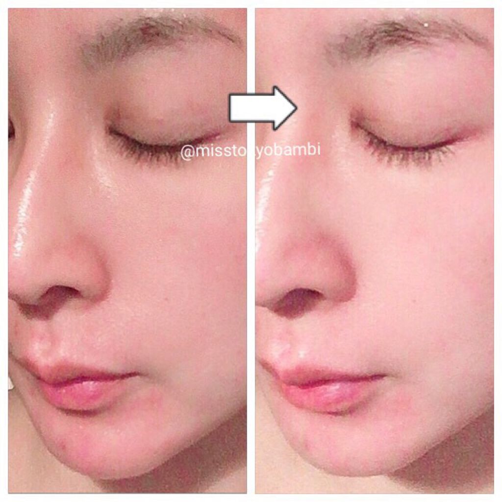 白ゆり@美容ブロガー on LIPS 「湘南美容外科でダーマペン4を受けてきたその後🙋🏻♀️✨୨୧┈..」(3枚目)