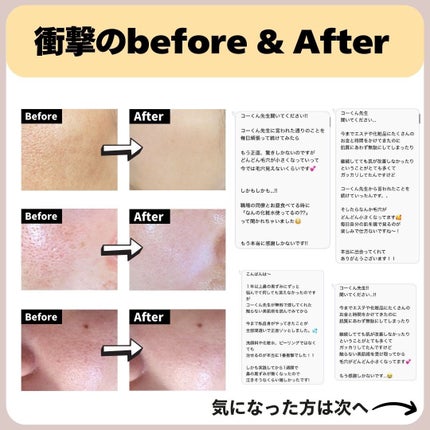 あなたの肌に合ったスキンケア💐コーくん先生 on LIPS 「【先着10名限定プレゼント🎁】毛穴がエグいほど消える裏技..あ..」(6枚目)